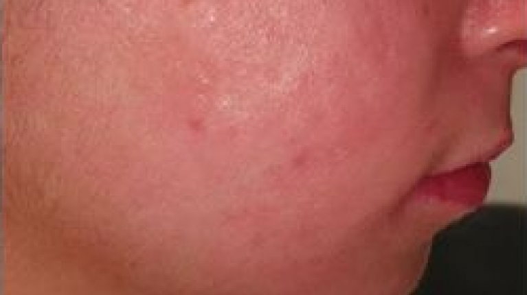 immagine 6 di Acne Giovanile e come curarla