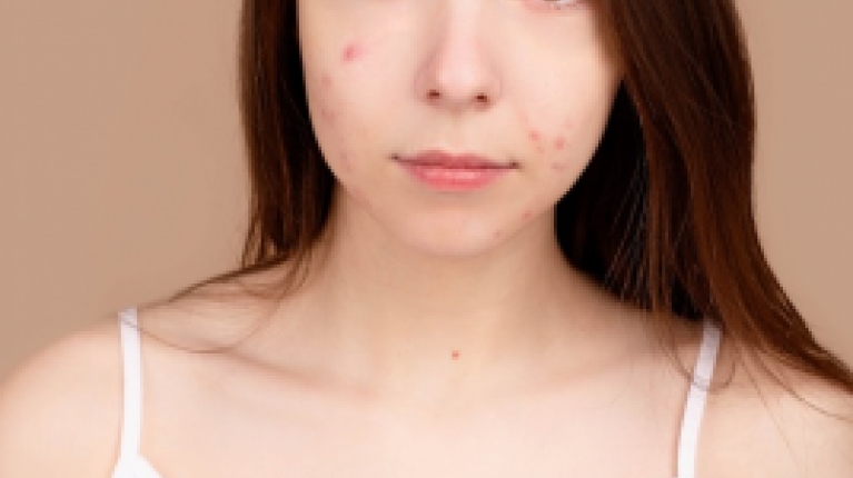 immagine 7 di Acne Giovanile e come curarla