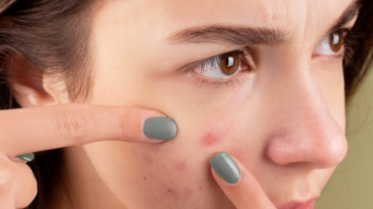 immagine 9 di Acne Giovanile e come curarla