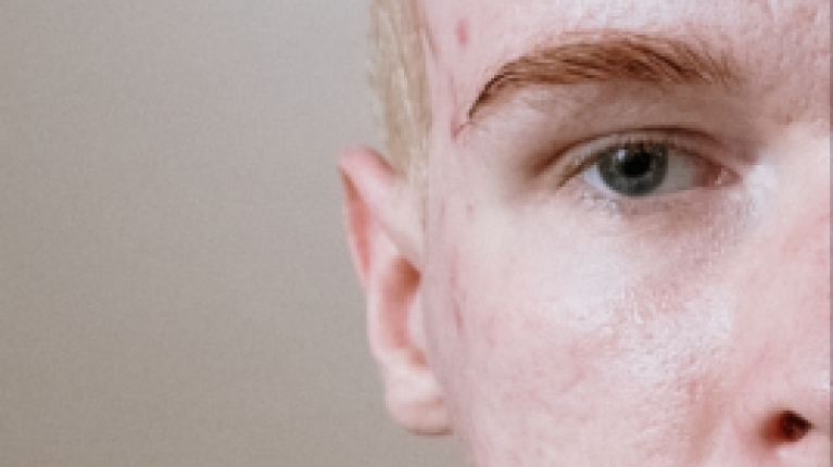 immagine 11 di Acne Giovanile e come curarla