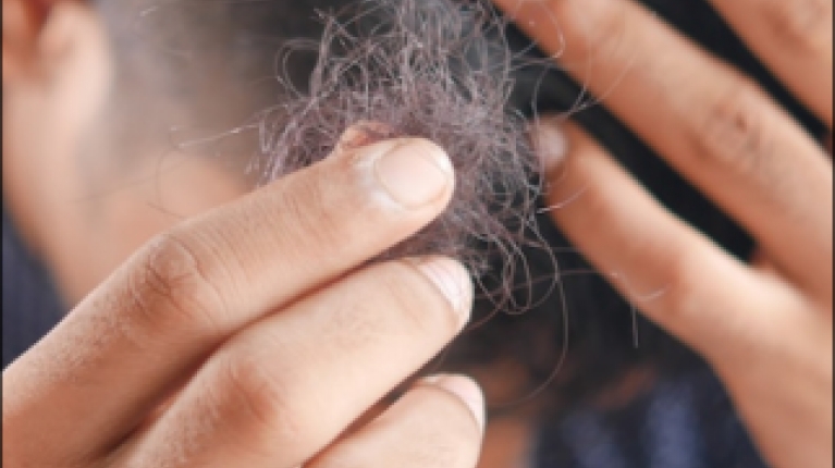 immagine 3 di Quando e perché cadono i capelli