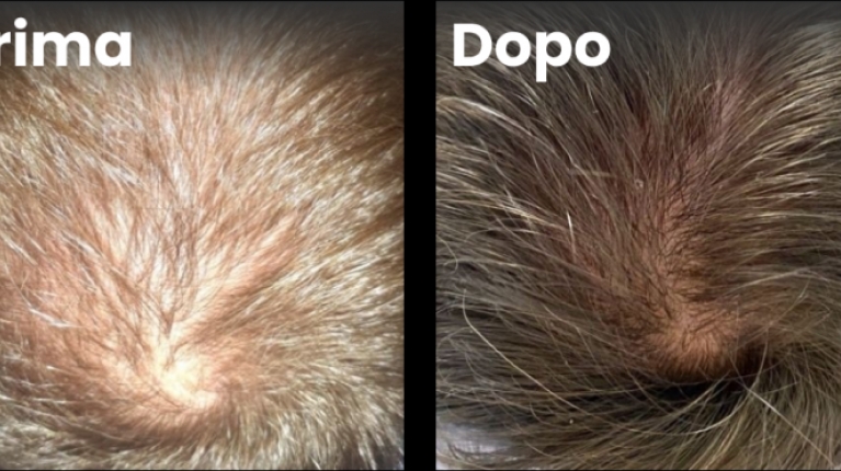 immagine 6 di Quando e perché cadono i capelli