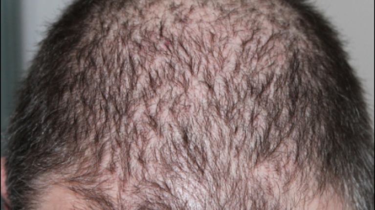 immagine 12 di Quando e perché cadono i capelli
