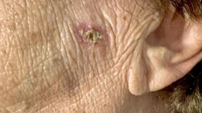 immagine 2 di Epiteliomi cutanei diagnosi trattamenti e cure