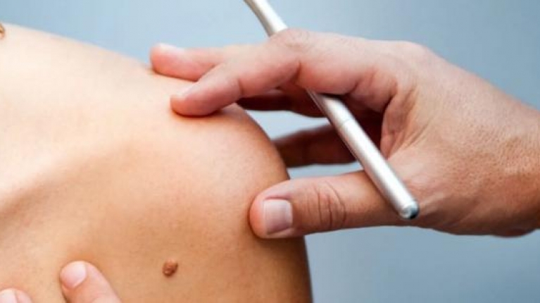 immagine 1 di Epiteliomi cutanei diagnosi trattamenti e cure