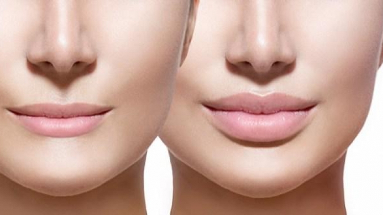 immagine 1 di Filler labbra o botox? Conosci la differenza?