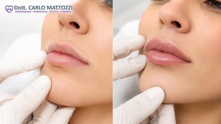 immagine 1 di Filler acido ialuronico contorno labbra