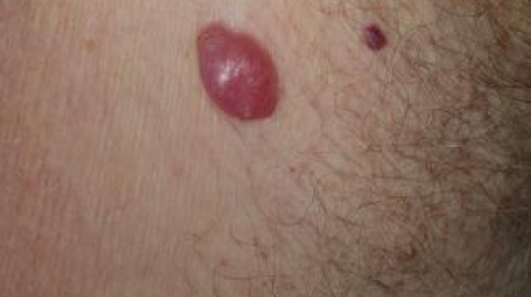 immagine 2 di Quando e perché un neo si trasforma in melanoma