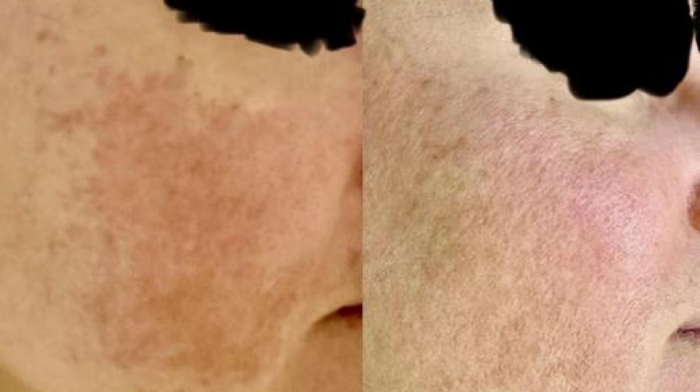 immagine 3 di Melasma viso cos'è e come curarlo
