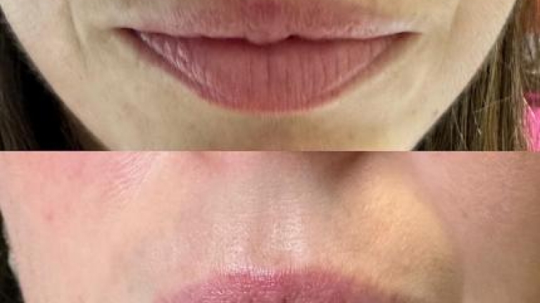 immagine 2 di Melasma viso cos'è e come curarlo