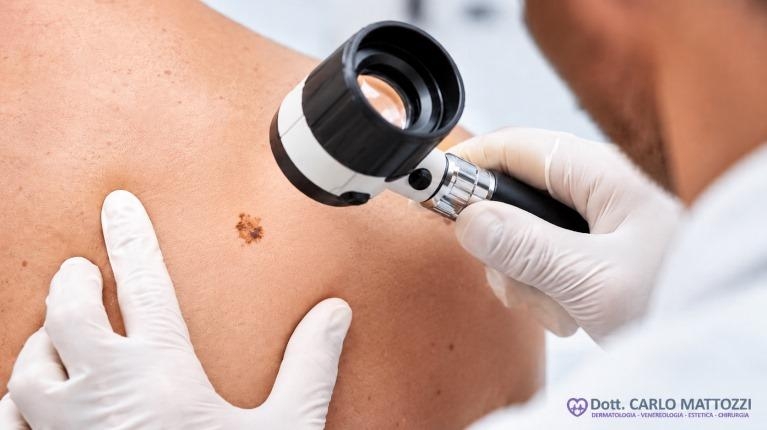 immagine 1 di Quando e perché un neo si trasforma in melanoma
