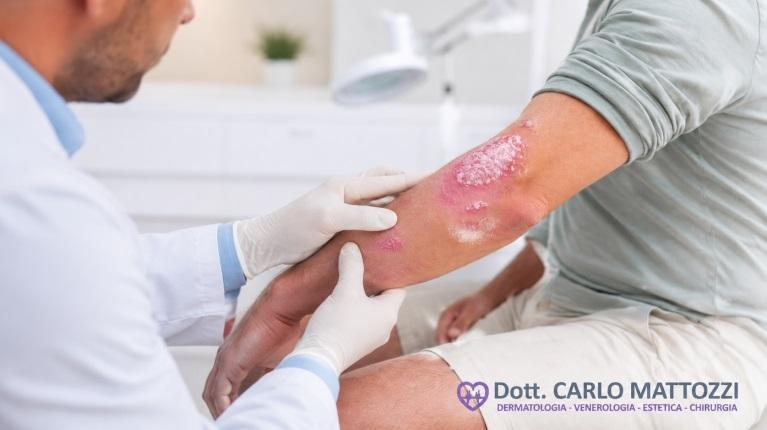 immagine 1 di Psoriasi, cause, rimedi e cura