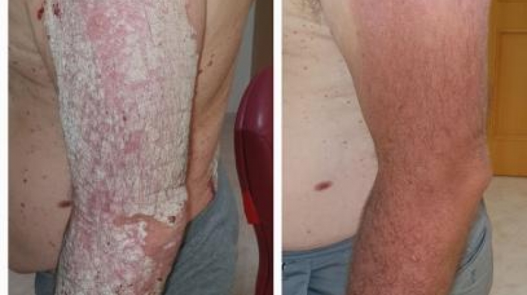 immagine 1 di Psoriasi, cause, rimedi e cura