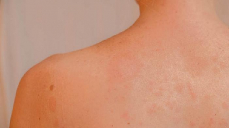 immagine 1 di Quali sono le malattie della pelle! Conoscerle per prevenirle