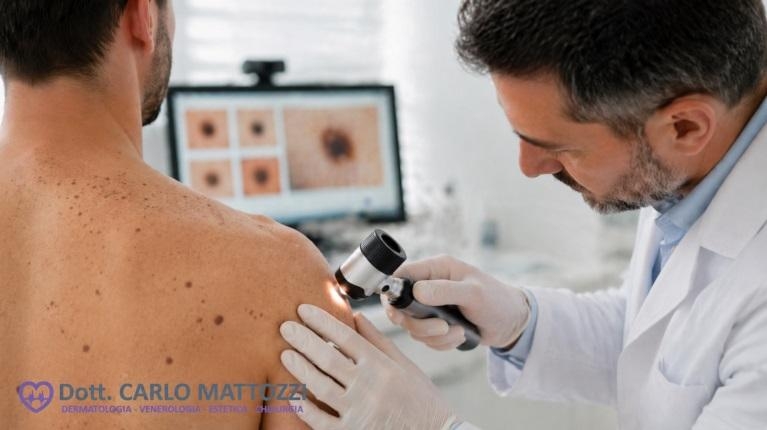 immagine 1 di Mappatura dei nei (nevi), controllo fondamentale del dermatologo