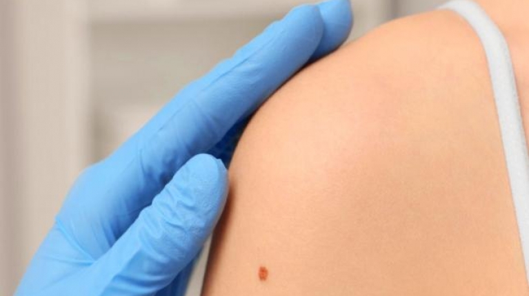 immagine 1 di Melasma viso cos'è e come curarlo