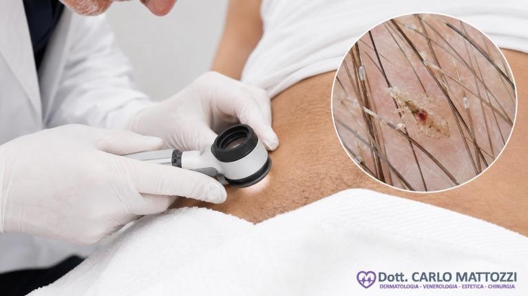 immagine 1 di Pediculosi pubica, diagnosi, trattamento e cura