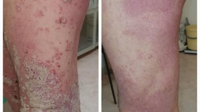 immagine 2 di Psoriasi, cause, rimedi e cura