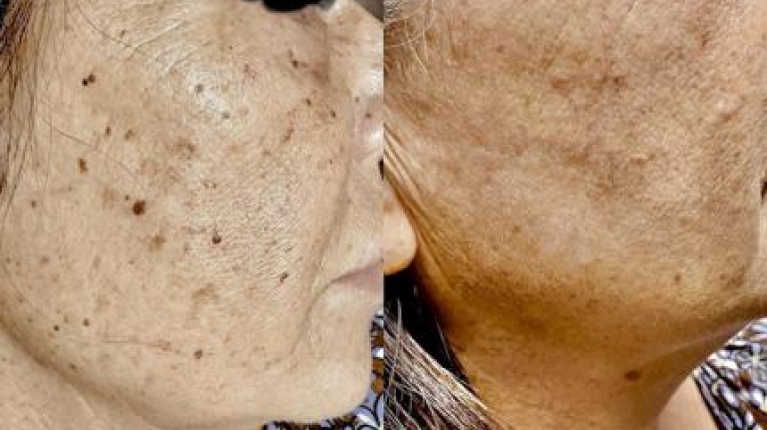 immagine 5 di Rimozione cheratosi seborroica con laser