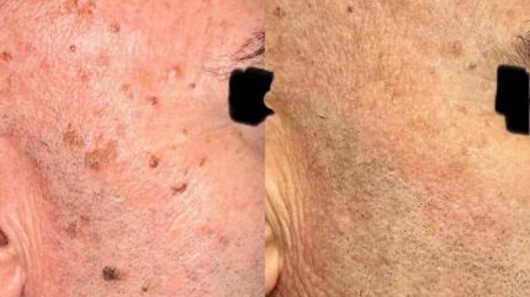 immagine 4 di Rimozione cheratosi seborroica con laser