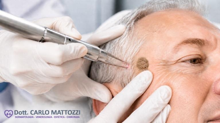immagine 1 di Rimozione cheratosi seborroica con laser