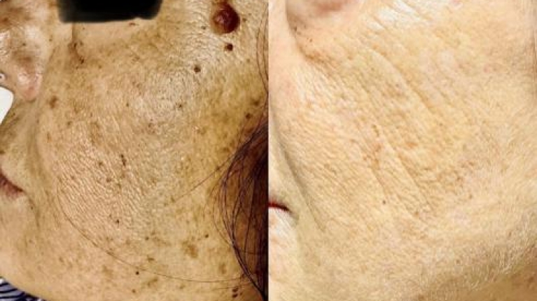 immagine 3 di Rimozione cheratosi seborroica con laser