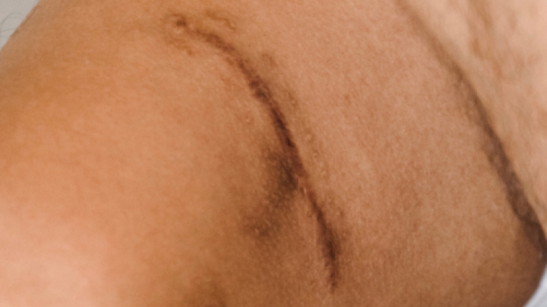immagine 3 di Come eliminare le cicatrici: trattamenti e rimedi