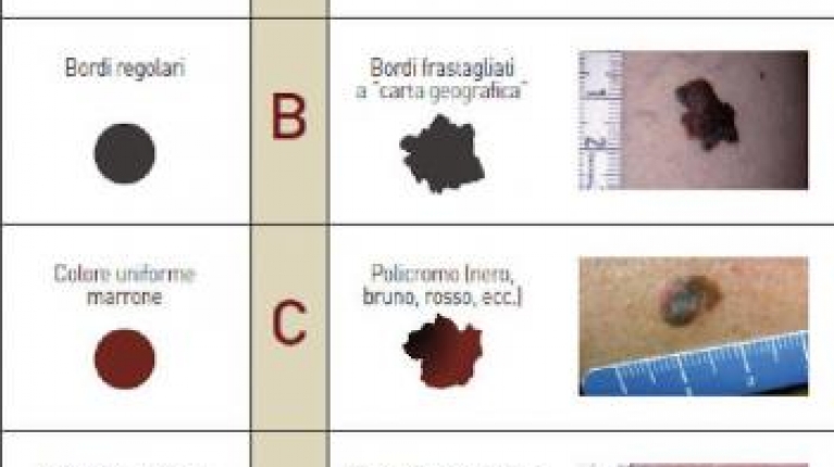 immagine 4 di Quando e perché un neo si trasforma in melanoma