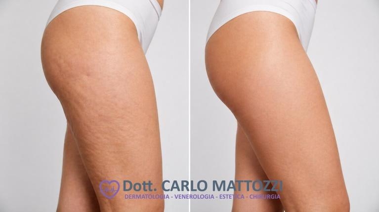 immagine 1 di Trattamenti anticellulite con la mesoterapia, cos'è e come funziona