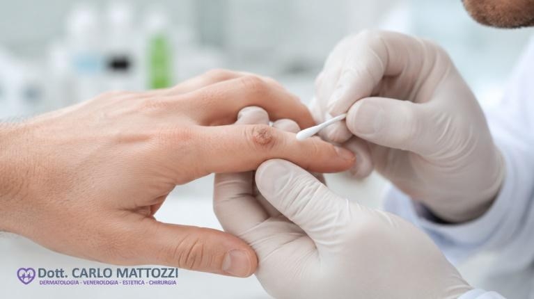 immagine 1 di Come trattare, curare ed eliminare le verruche