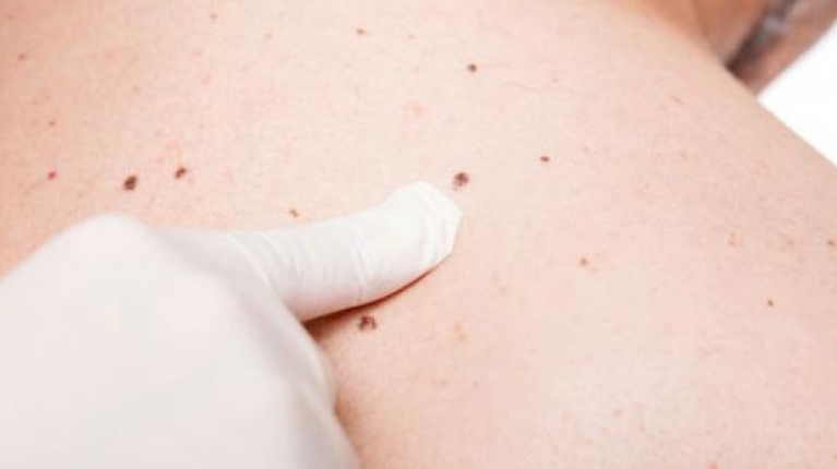 immagine 1 di Fare prevenzione con una prima visita dermatologica può essere vitale