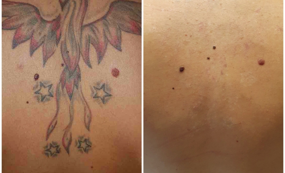 immagine 4 di Foto Trattamenti Estetici (prima e dopo)