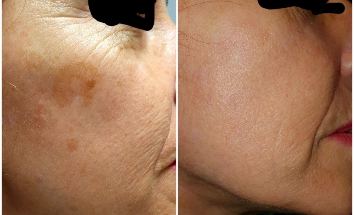 immagine 11 di Foto Trattamenti Estetici (prima e dopo)