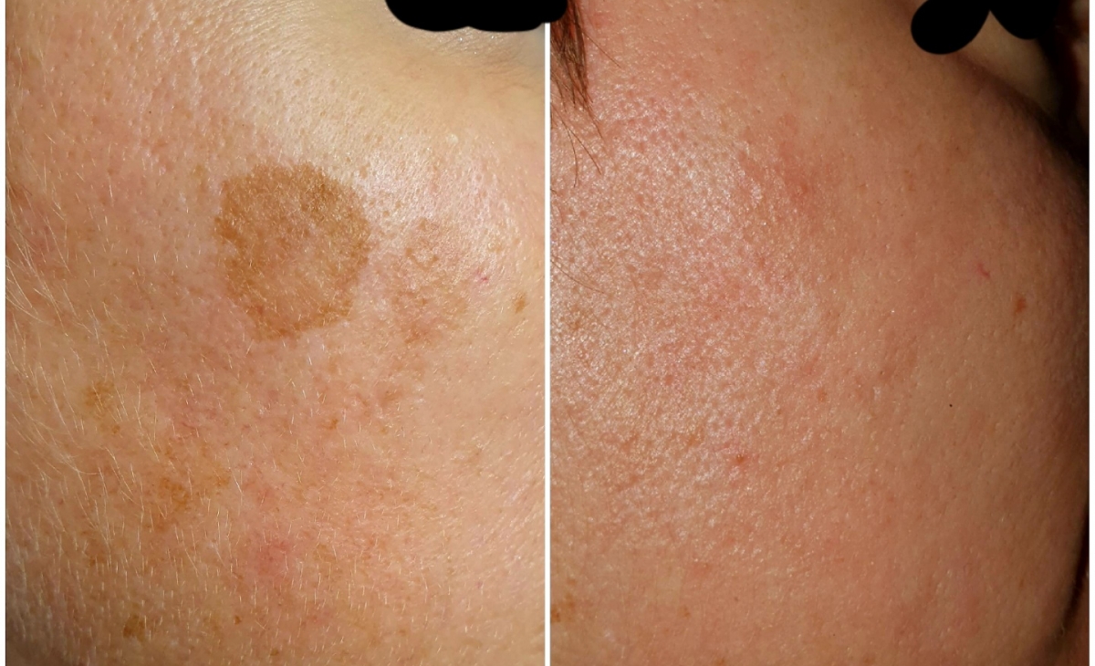 immagine 13 di Foto Trattamenti Estetici (prima e dopo)