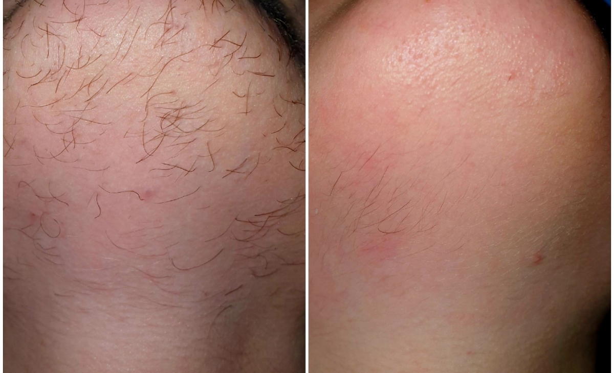 immagine 14 di Foto Trattamenti Estetici (prima e dopo)