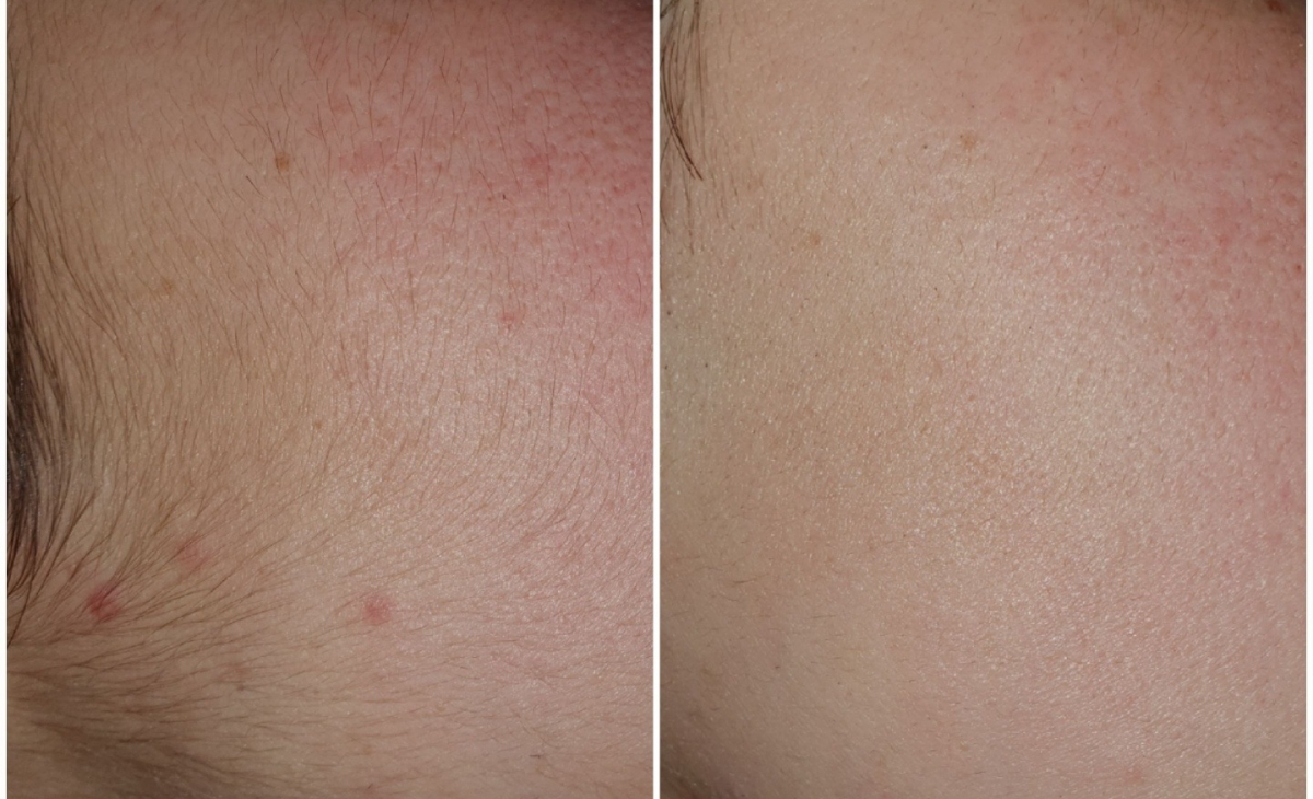 immagine 23 di Foto Trattamenti Estetici (prima e dopo)