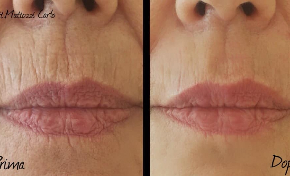 immagine 27 di Foto Trattamenti Estetici (prima e dopo)